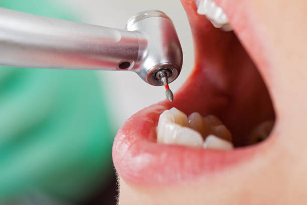 Best Emergency Tooth Extraction in Pearson, GA